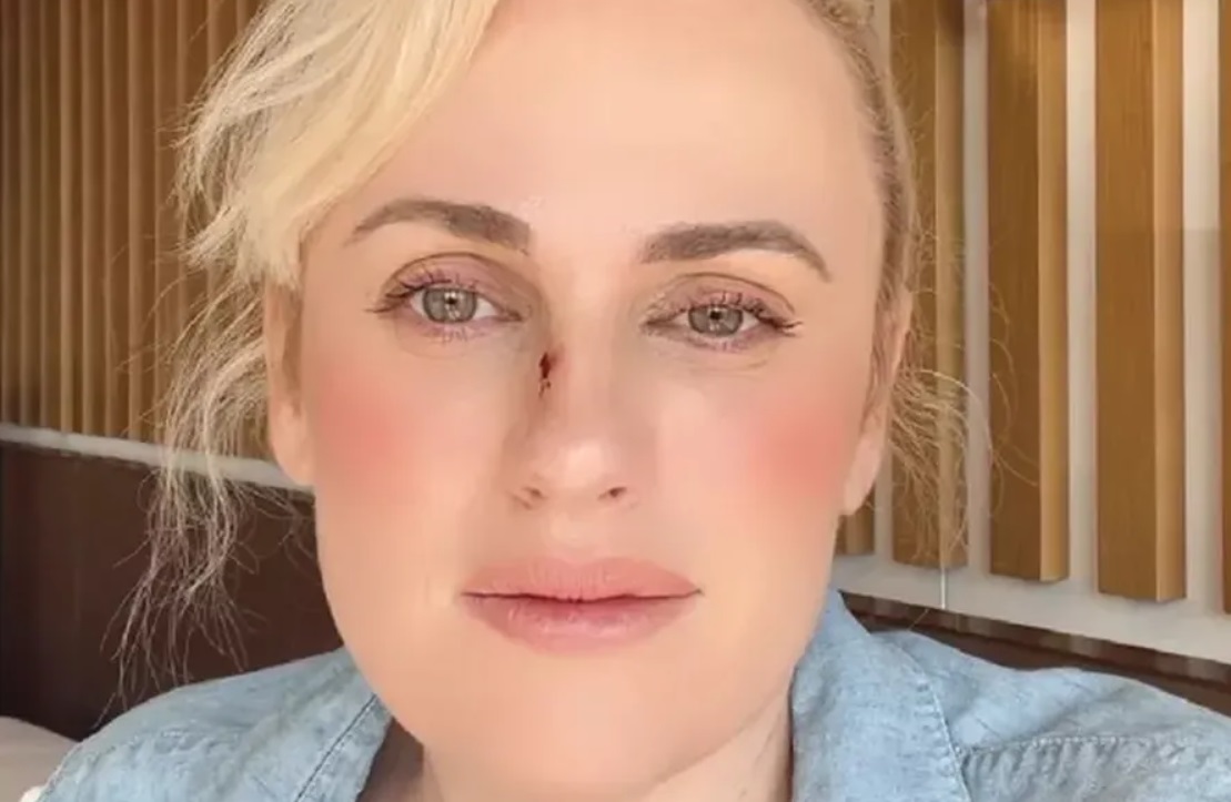 Atriz Rebel Wilson sofre acidente em set e atualiza estado de saúde
