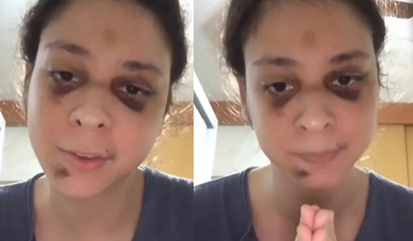 Com rosto machucado, Victor Meyniel agradece apoio após sofrer agressão por homofobia