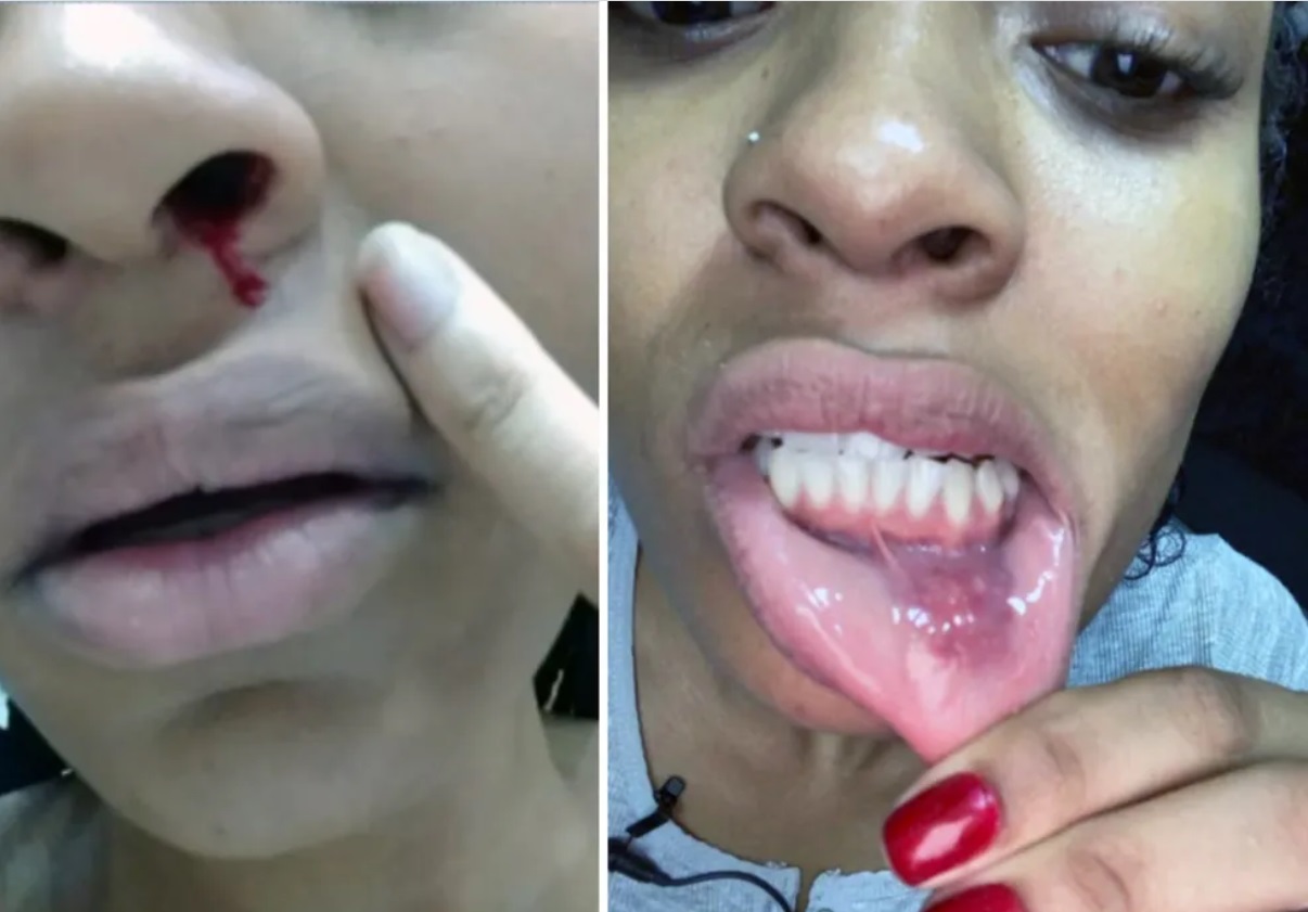Patrícia Ramos mostra ferimentos após denunciar o ex por agressão e outros crimes